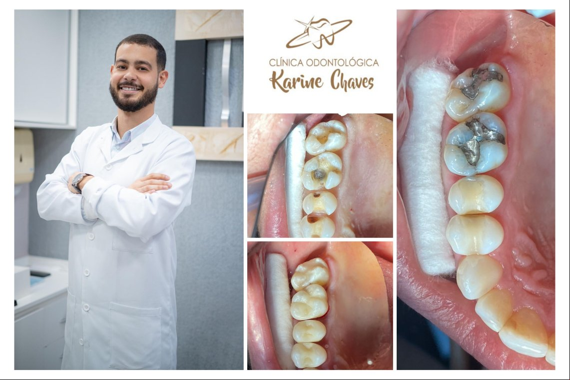 Clínica Odontológica Karine Chaves: restaurações em resina composta: como funcionam e qual a importância?